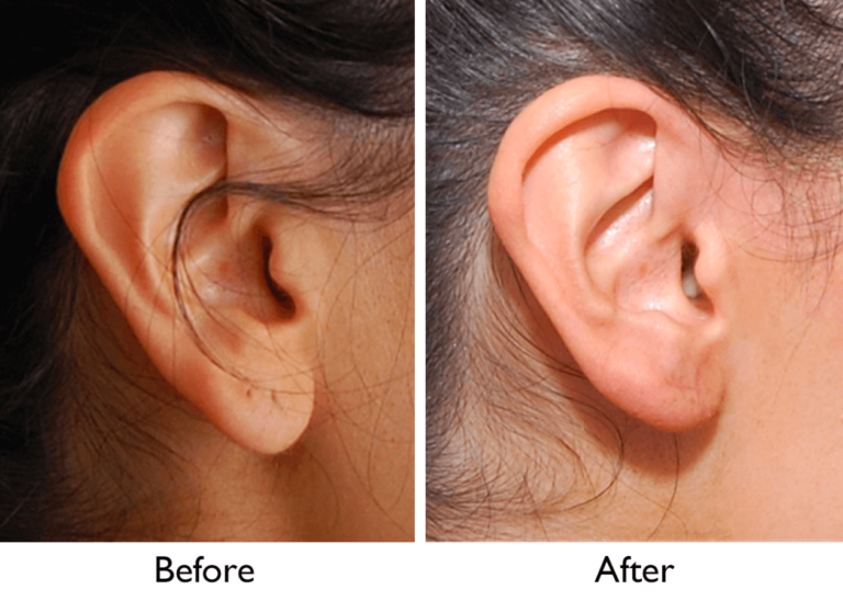 earlobe repair surgery